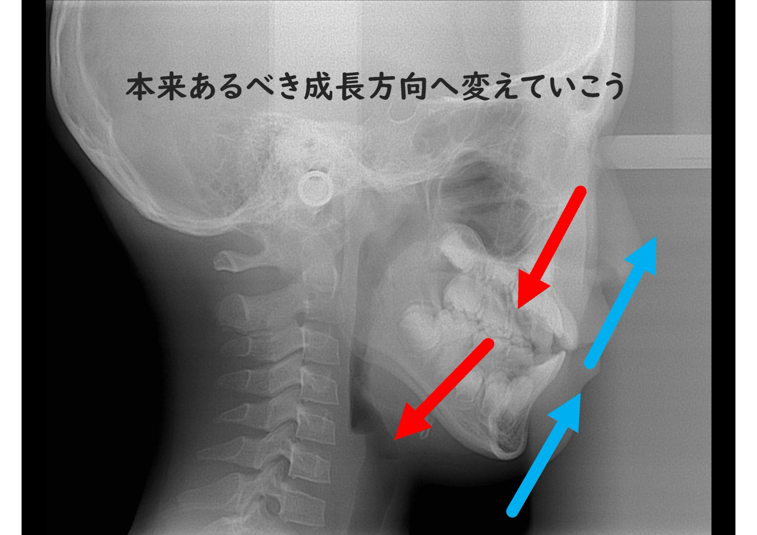 舌の位置と気道の関係