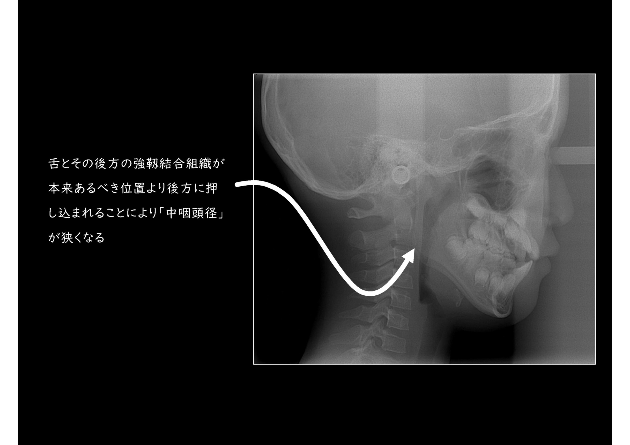 顎の成長方向と気道